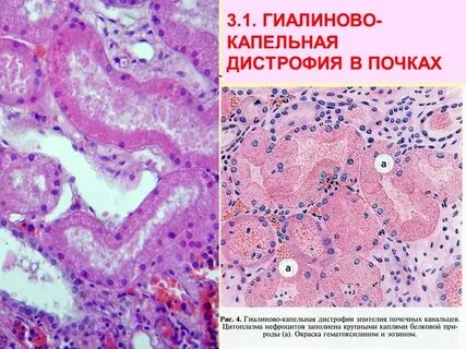 Паренхиматозные дистрофии патанатомия