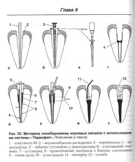 Пасты пломбирования каналов зубов. Обтурация корневых каналов системой "Термафил". Пломбирование корневого канала системой Термофил. Верификатор Термофил. Стандартная техника расширения корневых каналов конусность.