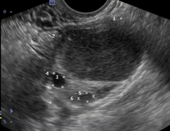 Эндометриоидная киста яичника на УЗИ. Параовариальная киста на УЗИ. Фолликулярная киста яичника на снимке. Эндометриоидная киста тела матки. Можно ли спутать кисту