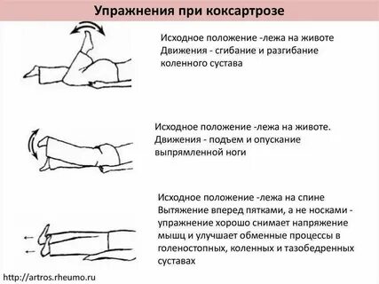 Гимнастика для коксартроза тазобедренного сустава 2 степени