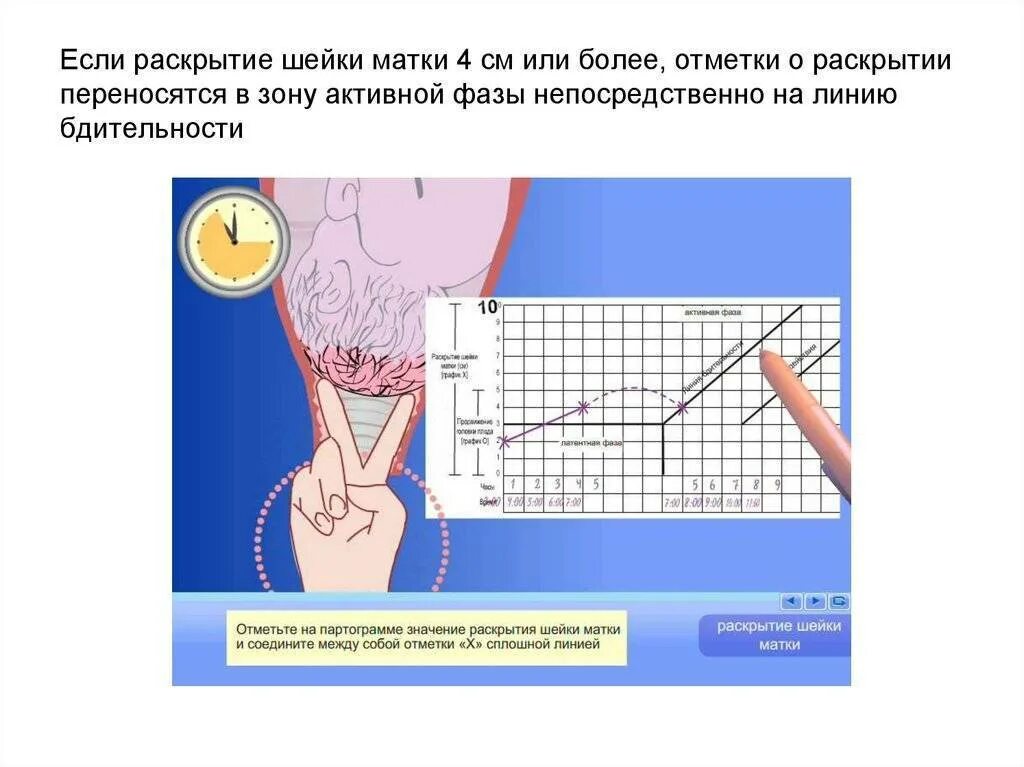 Этапы раскрытия шейки матки. Раскрытие шейки матки во время родов. Как проверяют раскрытие шейки матки. Шейка матки раскрытие. Шейка при родах сколько