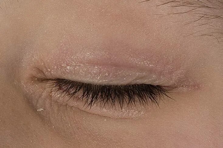 Сухая кожа глазами. Периорбитальный дерматит. Себорейный дерматит кожи век. Периорбитальный дерматит век. Себорейный дерматит вокруг глаз.