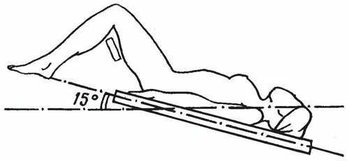 Положение тренделенбурга применяется при. Положение тренделенбурга. Положение тренделенбурга. Положение тренделенбурга. Поза тренделенбурга.