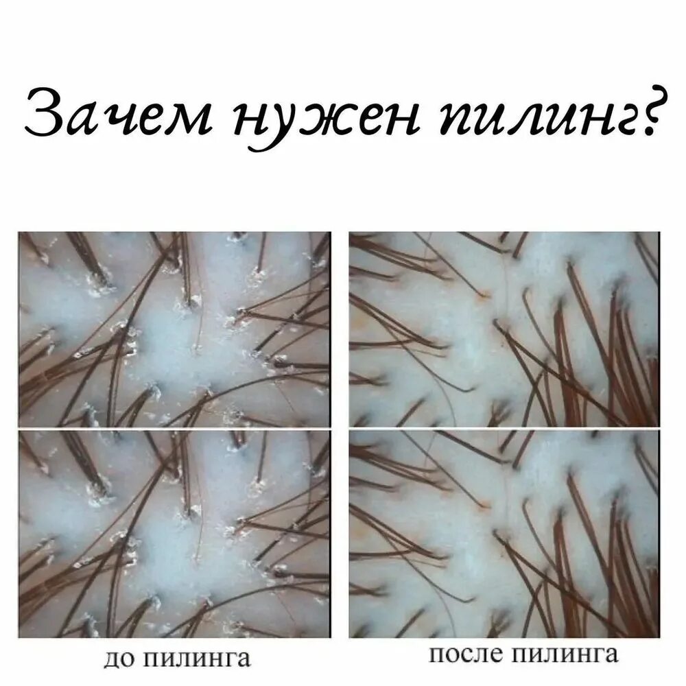 Какая бывает кожа головы. Себорейная алопеция фототрихограмма. себорейный дерматит фототрихограмма. пилинг для кожи головы.