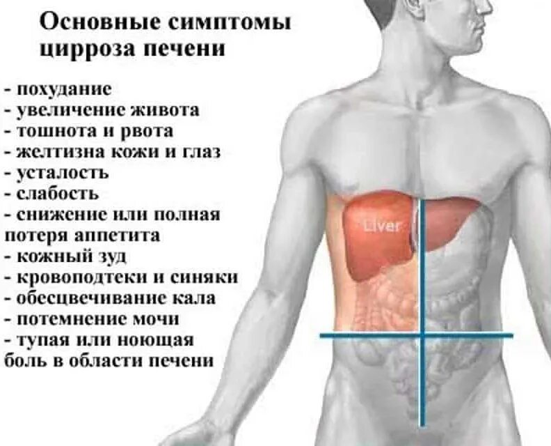 Колет там. Симптомы цейрозы печени. Симптомы церозапечент. Если болит печень симптомы.