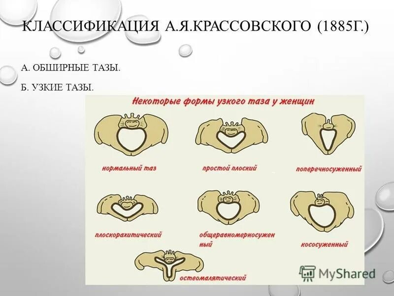 Кесарево узкий таз. Формы таза. Типы строения таза. Аномальные формы таза.