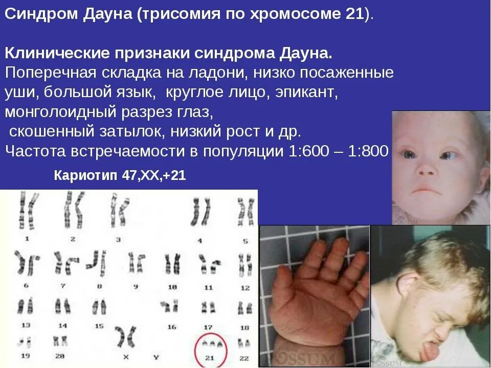 Синдром Дауна трисомия 21. Мозаичная трисомия синдрома Дауна. Синдром Эдвардса (трисомия в 18-Ой хромосоме).. Синдром Патау трисомия по 13 хромосоме. Наличие лишней хромосомы