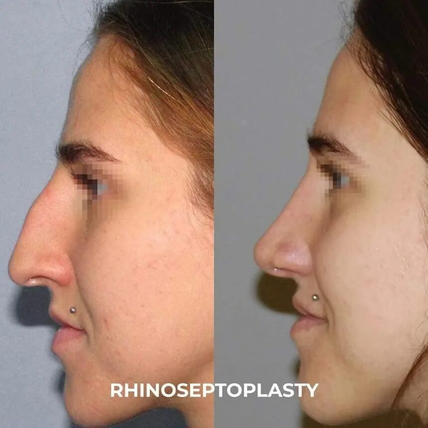 Рост носа в год. Нос с горбинкой до и после операции. Кукольный носик ринопластика фото. Риносептопластика. Аларпластика до после.