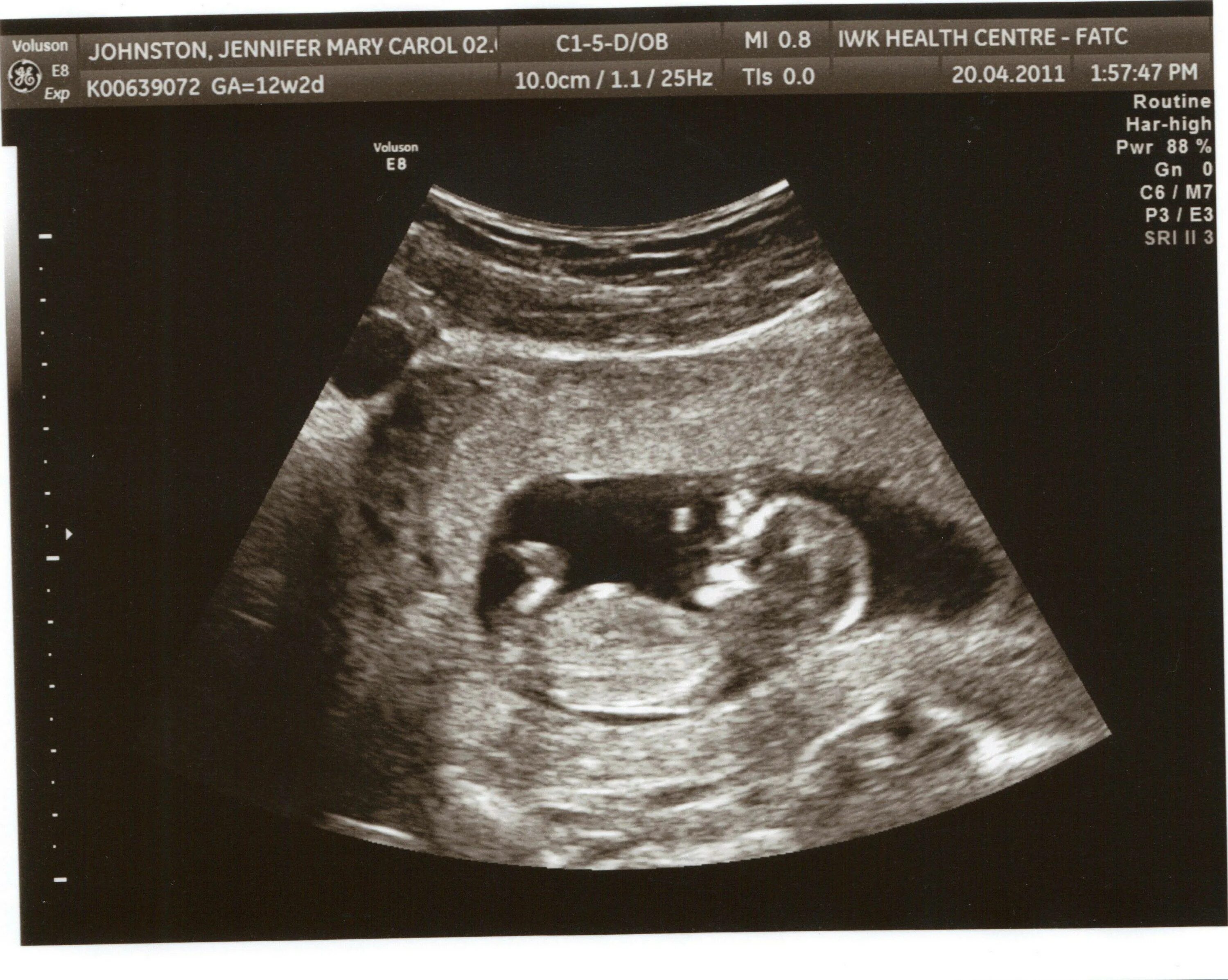 12 Недель беременности фото ребенка плода на УЗИ. Снимок УЗИ на 12 неделе беременности. УЗИ на 12 неделе беременности фото плода на УЗИ. Эмбрион на 12 неделе беременности УЗИ. Почему на 10 неделе беременности