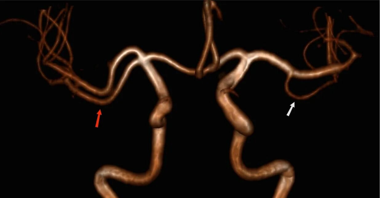 Гипоплазия червя. Аномалии позвоночных артерий. Разрыв аневризмы виллизиевого круга. Гипоплазия правой позвоночной артерии.