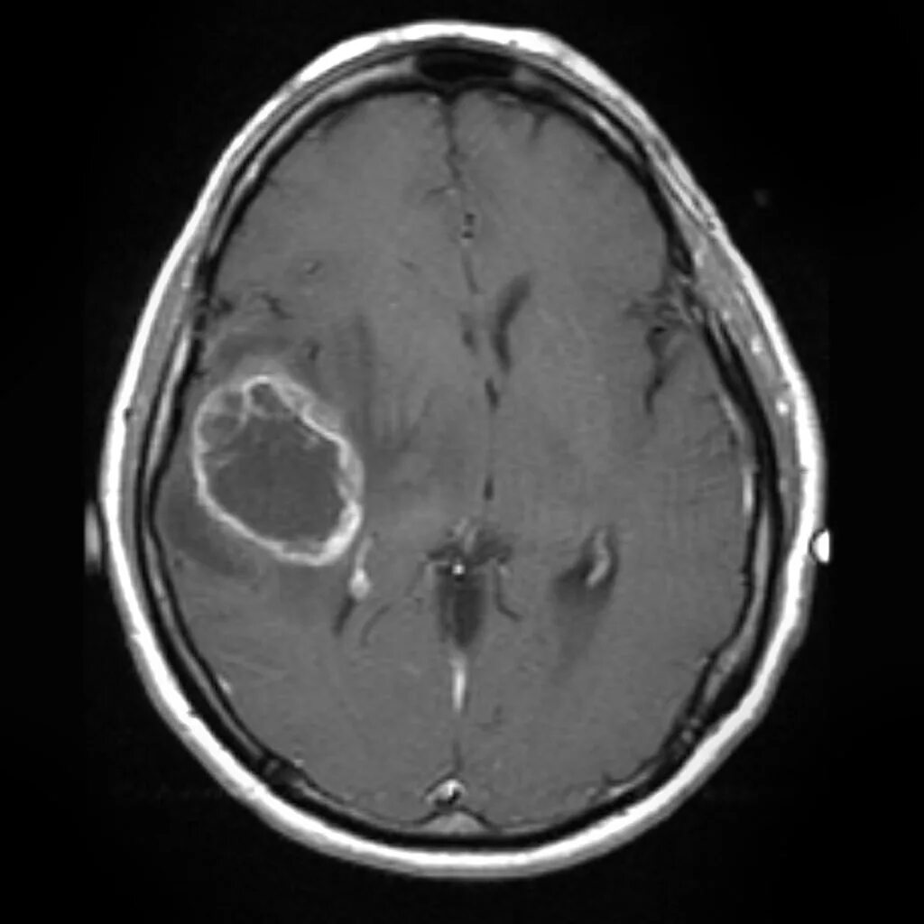 Глиома лечение. Мультиформная глиобластома мрт. Глиобластома головного мозга мрт. Глиобластома на мрт мозга.