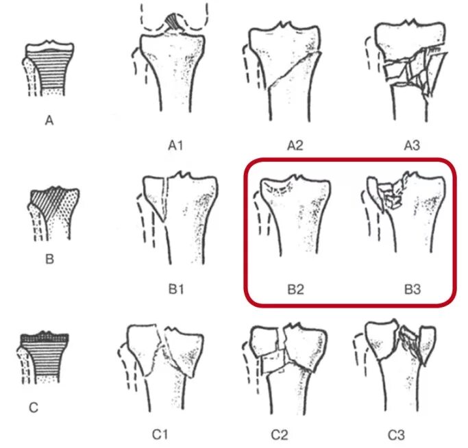 Внутрисуставной перелом мыщелка. Переломы проксимального отдела большеберцовой кости классификация. Переломы мыщелков большеберцовой кости классификация. Перелом мыщелка большеберцовой кости классификация. Классификация переломов большеберцовой кости по АО.