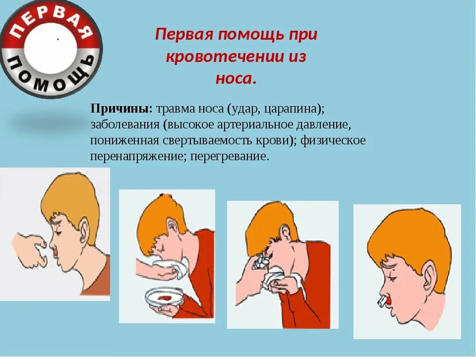 Что делать при кровотечении из носа. Оказание первой помощи при кровотечении из носа. оказание первой медицинской помощи при кровотечении из носа. кровотечение из носа пмп. оказание первой медицинской помощи при кровотечениях bp yjcf.