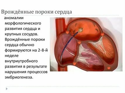 Врожденное сердечное заболевание