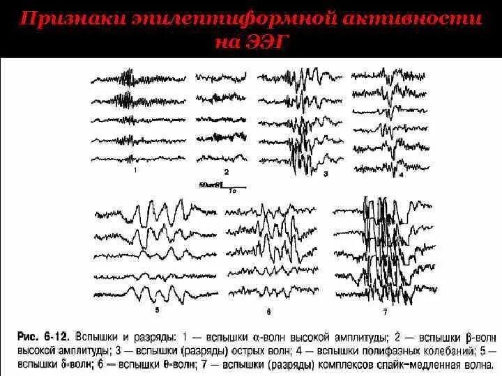 Диффузная эпилептиформная активность. Эпилептиформные паттерны на ЭЭГ. ЭЭГ при эпилептическом припадке. ЭЭГ больного эпилепсией. Патологические ритмы ЭЭГ при эпилепсии.