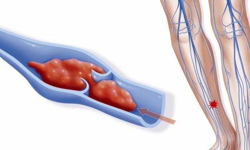 Венозная тромбоэмболия. Постинъекционные осложнения флебит. Эмболия тромбы