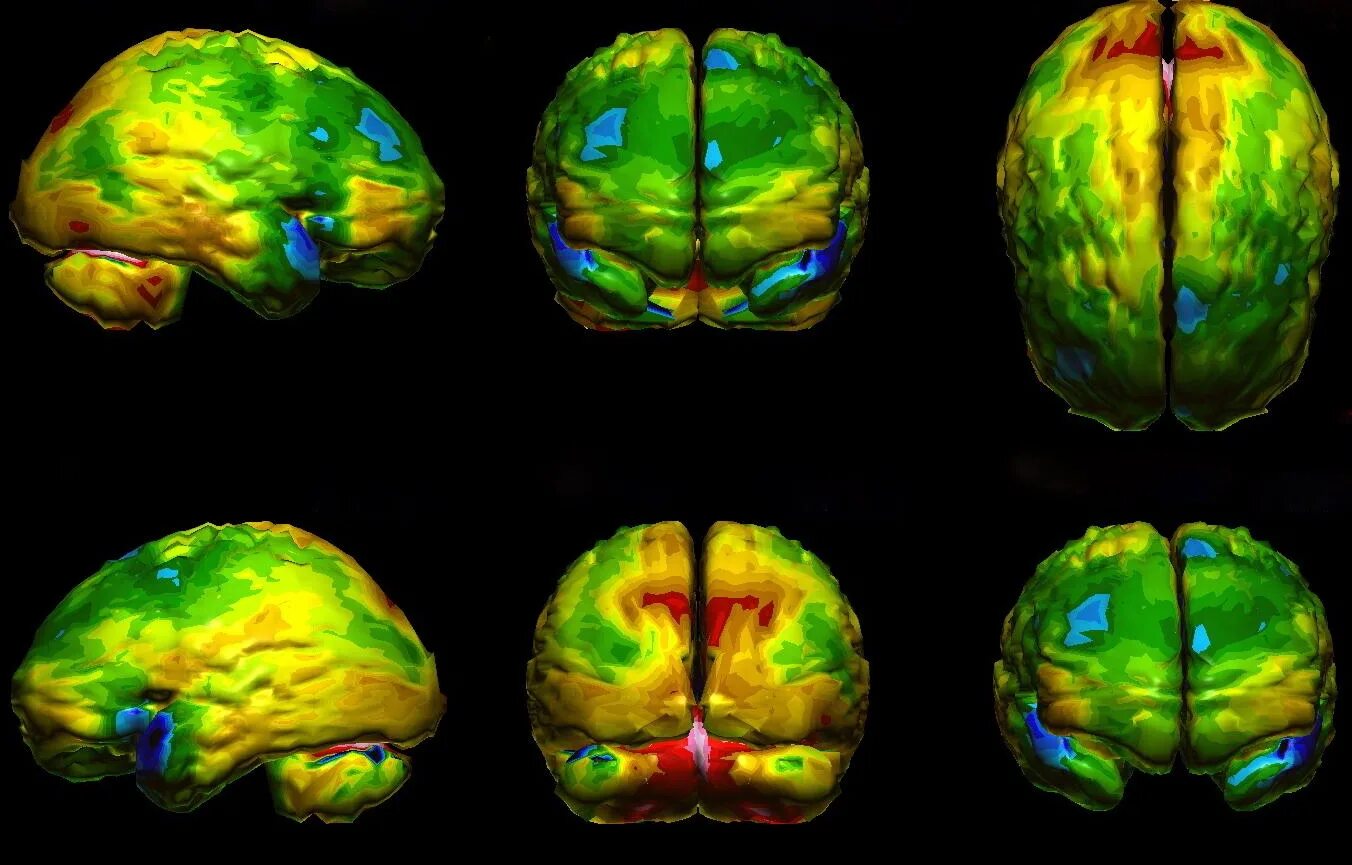 Позитронно-эмиссионная томография головного мозга. Однофотонная эмиссионная компьютерная томография мозга. ПЭТ/ОФЭКТ/мрт. ОФЭКТ головного мозга.