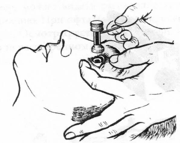 Маклаков внутриглазного давления. Тонометрия (измерение глазного давления). Тонометрия тонометром Маклакова. Тонометрия по маклакову (измерение внутриглазного давления). Тонометр для измерения внутриглазного давления по маклакову.