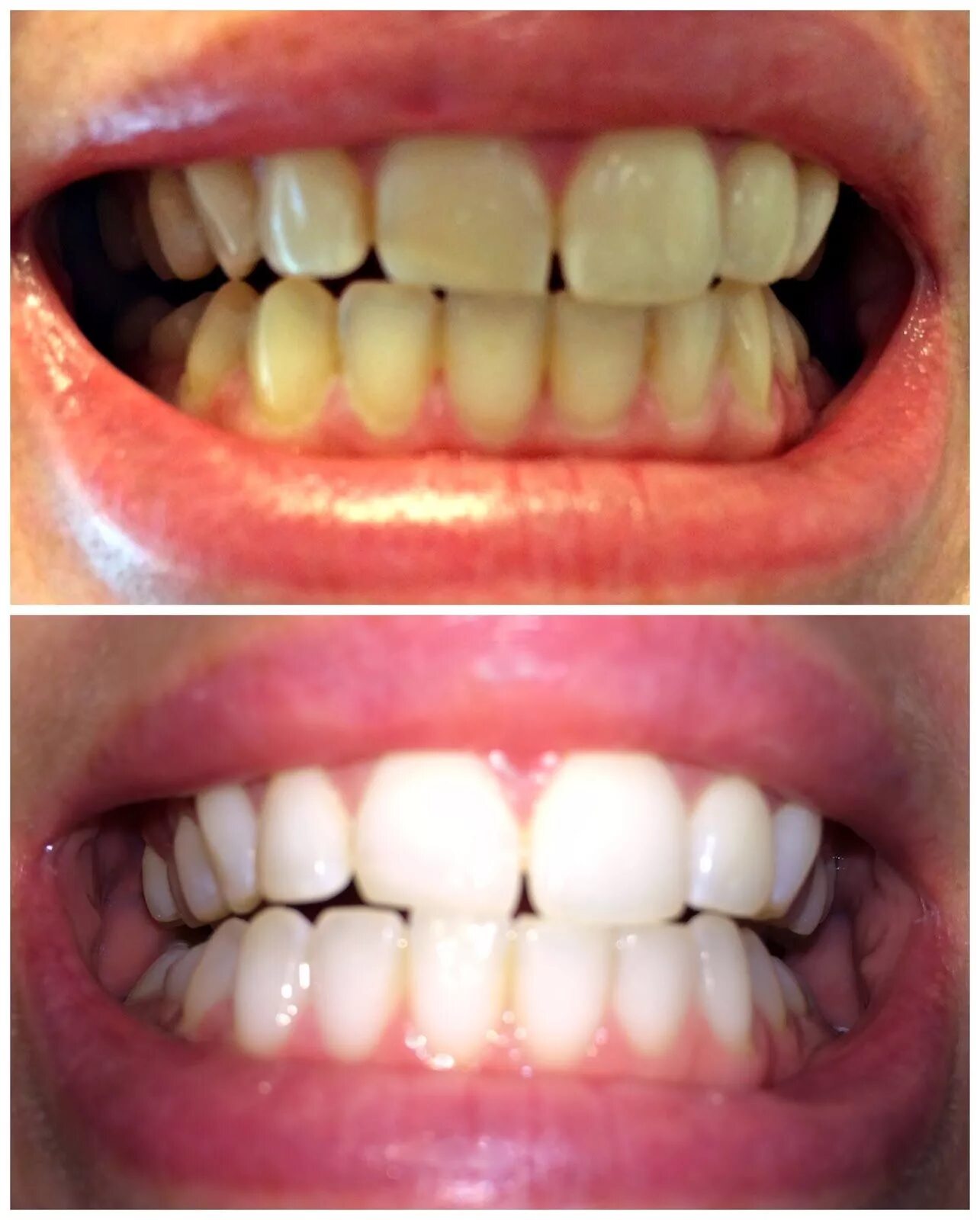 Отбеливание зубов до и после. Зубы до и после отбеливания.