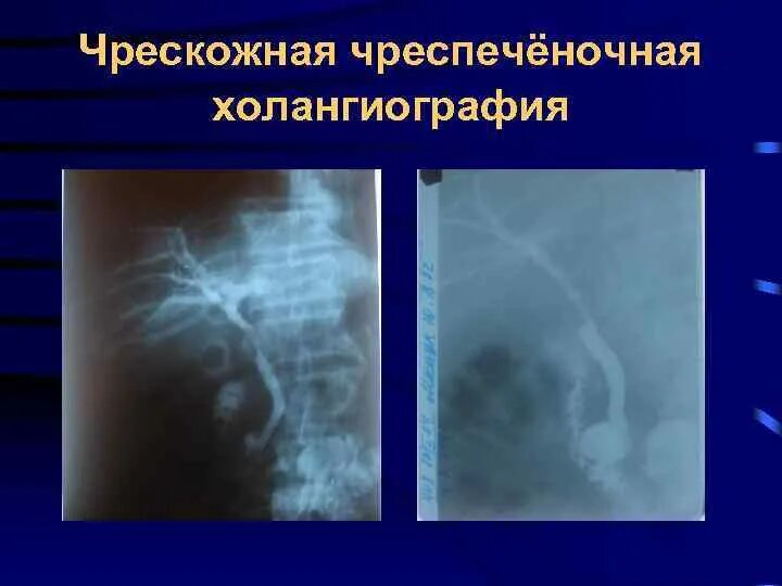 Чрескожная чреспеченочная дренирование желчных протоков. Чрескожная чреспечёночная холангиография. Чреспеченочная холангиография. Чрескожная чреспеченочная холангиография (ччхг). Чркзкожная чрезпеченочная холангиангиография.