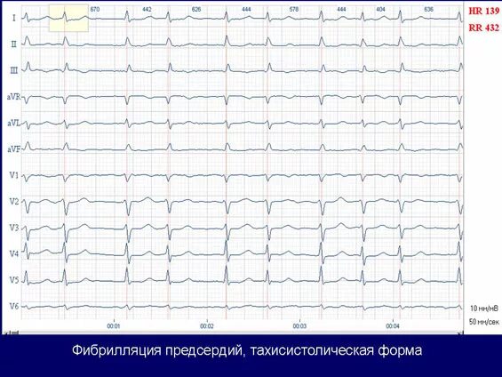Фибрилляция предсердий клинические рекомендации. Длительно персистирующая фибрилляция предсердий. Экг мерцательная аритмия мерцание желудочков. Av reentrant tachycardia. Avnrt.