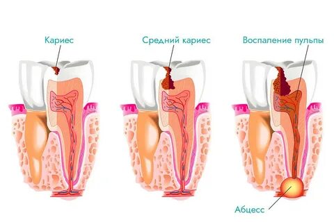 Пульпит степени