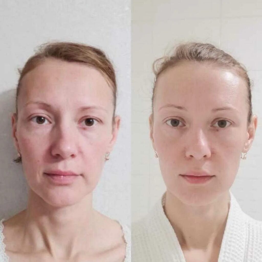 Поднимал какое лицо. Пластический массаж лица фото до и после. Массаж лица до и после. Фейсбилдинг до и после.
