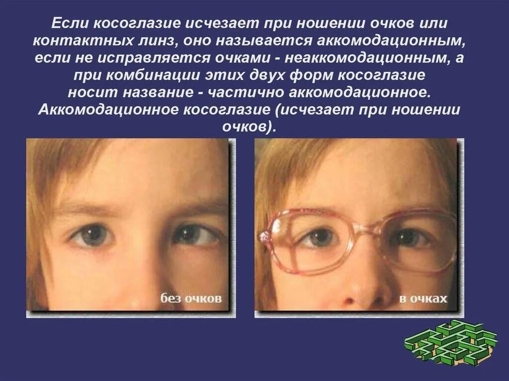 Операция лечения амблиопии у взрослых