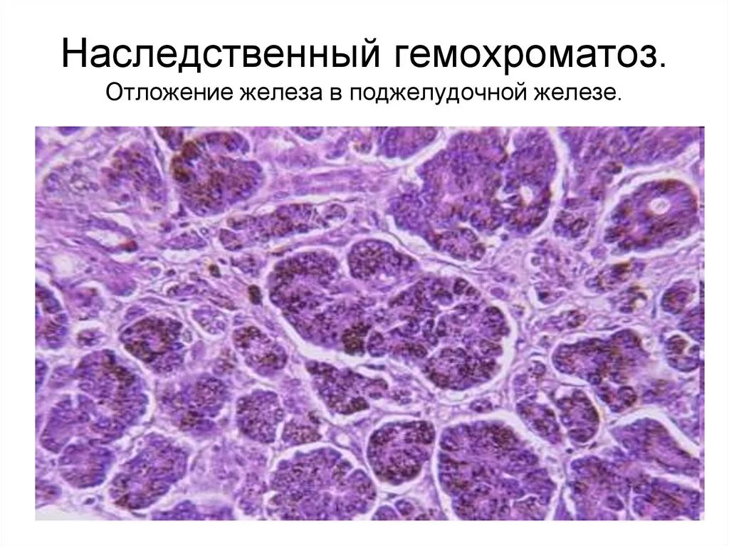 Без гемохроматозов
