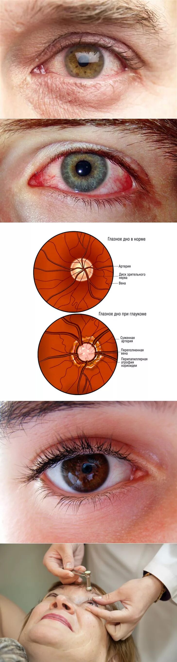 Глазное давление у детей. Внутриглазное давление симптомы. Внутриглазное давление глаза.