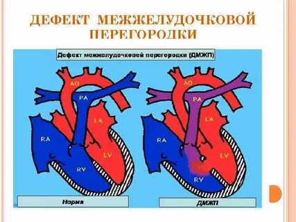 Гемодинамика межжелудочковой перегородки