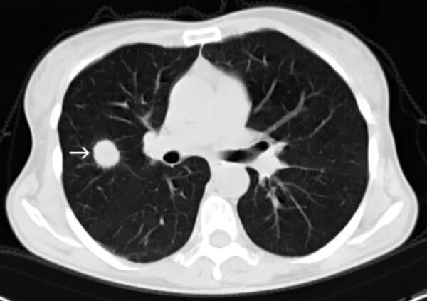 Бронхогенная карцинома на кт. Кт грудной клетки онко. Легочная карцинома кт.