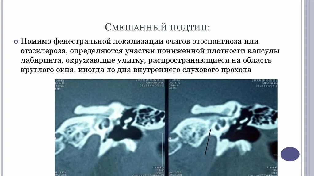 Кохлеарный отосклероз. Фенестральный отосклероз на кт. смешанная форма отосклероза кт. фенестральная форма отосклероза на кт. отосклероз на кт височных костей.