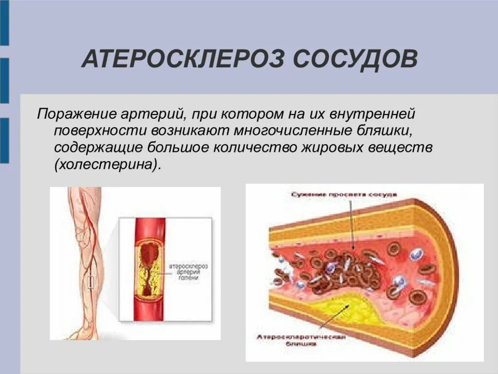 Атеросклеротическое поражение сосудов. Атеросклеротическая болезнь сердца. Атеросклероз презентация.