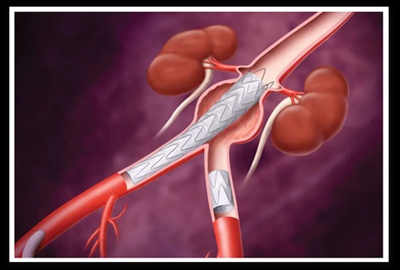 Аневризма стент. Стент графт брюшной аорты. Стент графт аорты операция. Стентирование брюшной аорты стент графт.