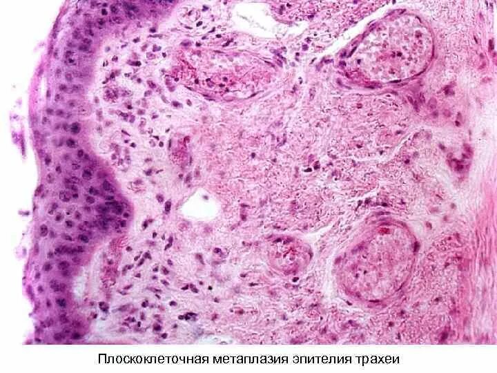 Плоскоклеточная метаплазия гистология. Базальноклеточная карцинома гистология. Метаплазированный эпителий шейки матки. Плоскоклеточный метаплазированный эпителий. Группы клеток метаплазированного