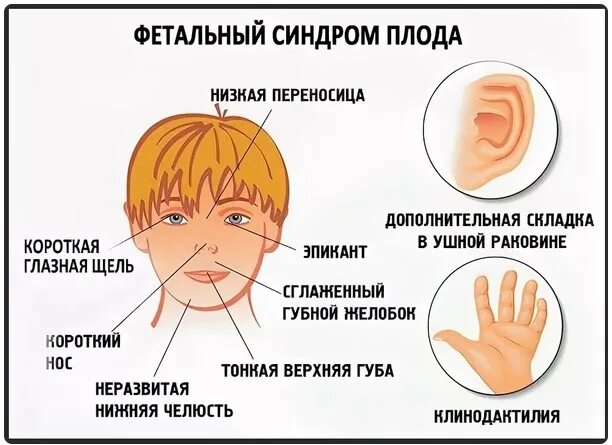 Синдром фас у детей как выглядит Fetal Alcohol Syndrome Face Adults 606