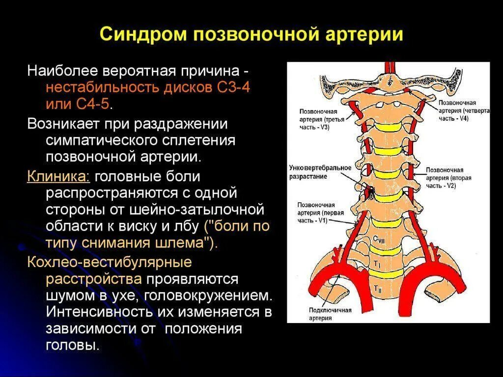 Шейный отдел позвоночника диагнозы. Шейный остеохондроз позвонки шейного отдела. Синдром позвоночной артерии с4. Вертебральный синдром позвоночной артерии. Синдром позвоночной артерии вертебро-базилярная недостаточность.