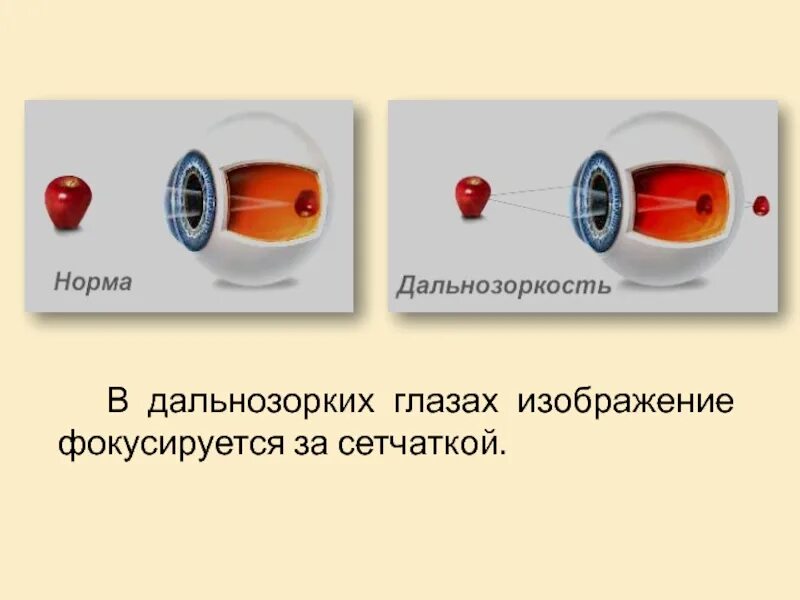 При дальнозоркости изображение предмета фокусируется. Фокусируются за сетчаткой. изображение фокусируется перед сетчаткой. изображение фокусируется позади сетчатки. у дальнозорких изображение фокусируется.