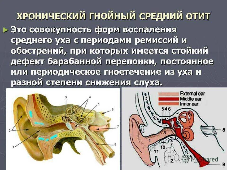 Барабанная перепонка отит. Хронический Гнойный наружный средний отит. Заболевание среднего уха –средний отит. Хронический туботимпанальный Гнойный средний отит клиника.