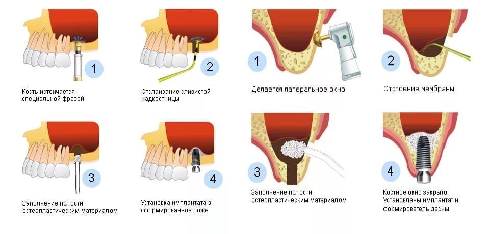 Пересадка кости. Синус лифтинг это наращивание костной ткани. Этапы операции синус лифтинга. Открытый синус лифтинг и мембраны.