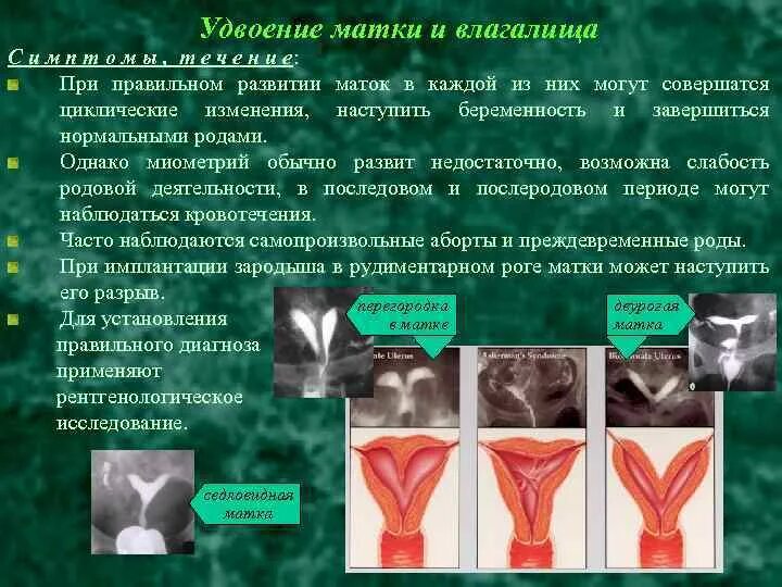 Может быть две матки. Удвоение матки и влагалища. патология удвоение матки.