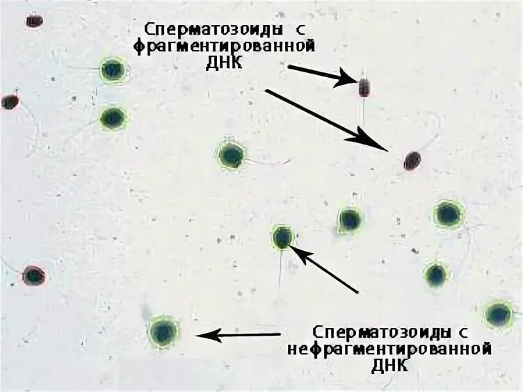 Днк спермограмма сдать. Спермограмма с днк фрагментацией. методика фрагментации днк сперматозоидов. фрагментация днк анализ. днк фрагментация спермограмма норма.