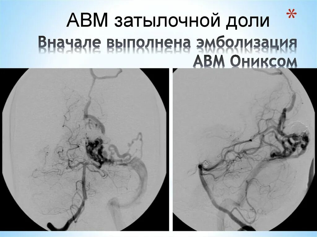 Эмболизация форум. Артериовенозная мальформация (авм). эмболизация авм сосудов головного мозга. эмболизация сосудистой мальформации. авм мальформация сосудов.