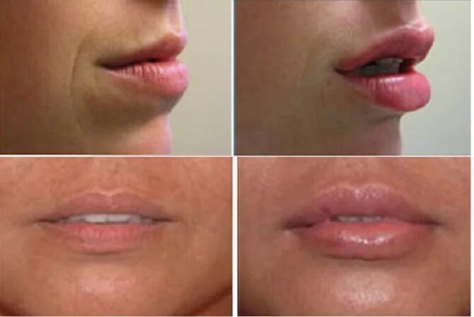 массаж для увеличения губ до и после. хейлопластика кессельринг. нужно ли разминать филлер. массаж губ после увеличения. рефрешинг губ гиалуроновой кислотой.