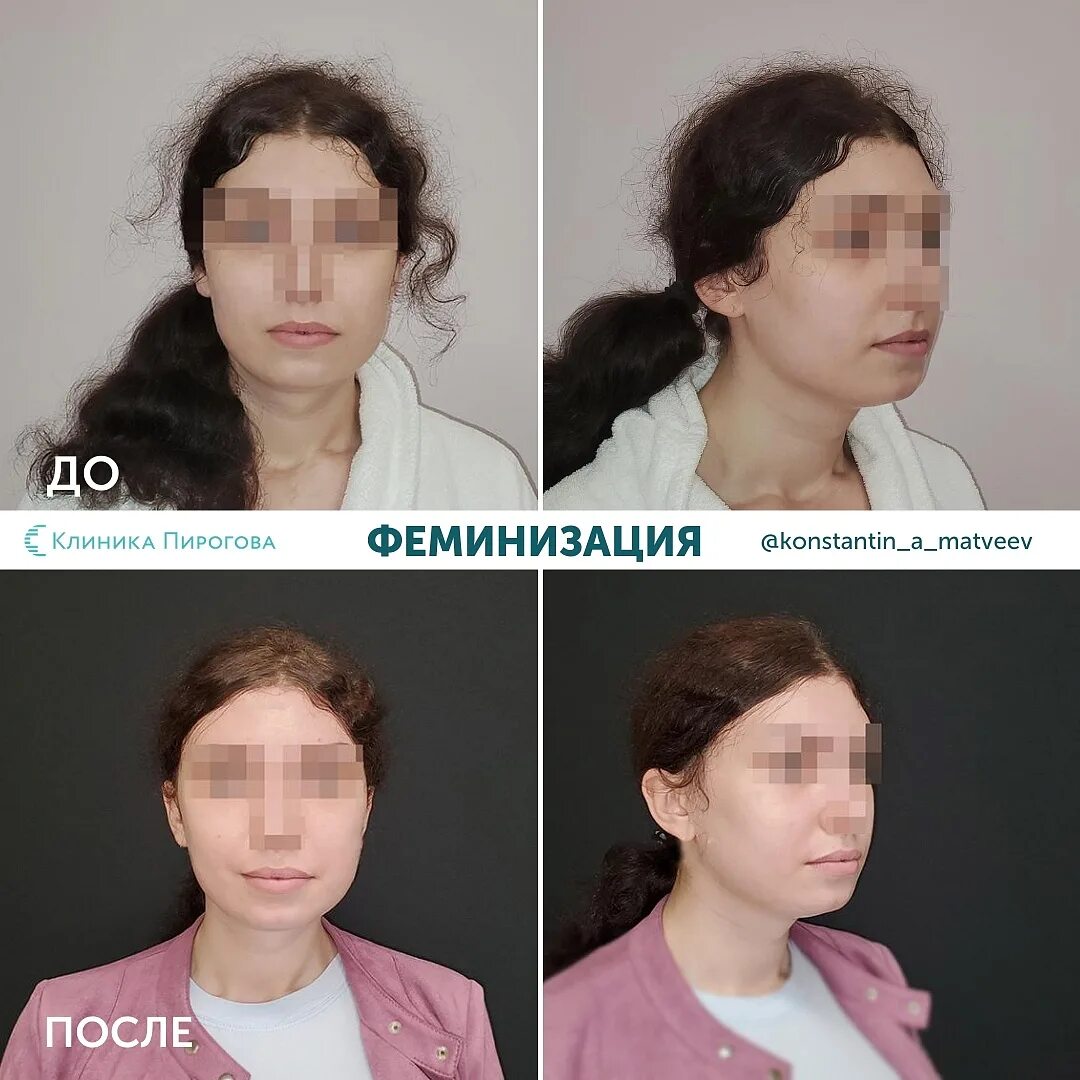Феминизация лица. Феминизация лица. Операция по феминизации лица. Операция по феминизации лица. Пексия бровей.