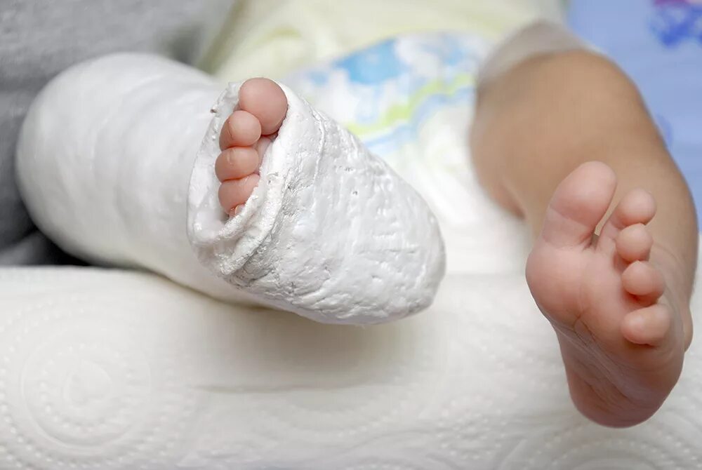 Врожденная эквиноварусная косолапость. Травма ноги ребенка-детский.