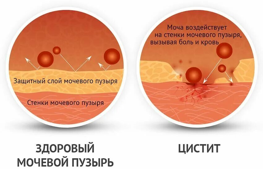 Как выглядит цистит у женщин. Лекарство цистит у женщин с кровью. острый цистит симптомы у женщин с кровью.