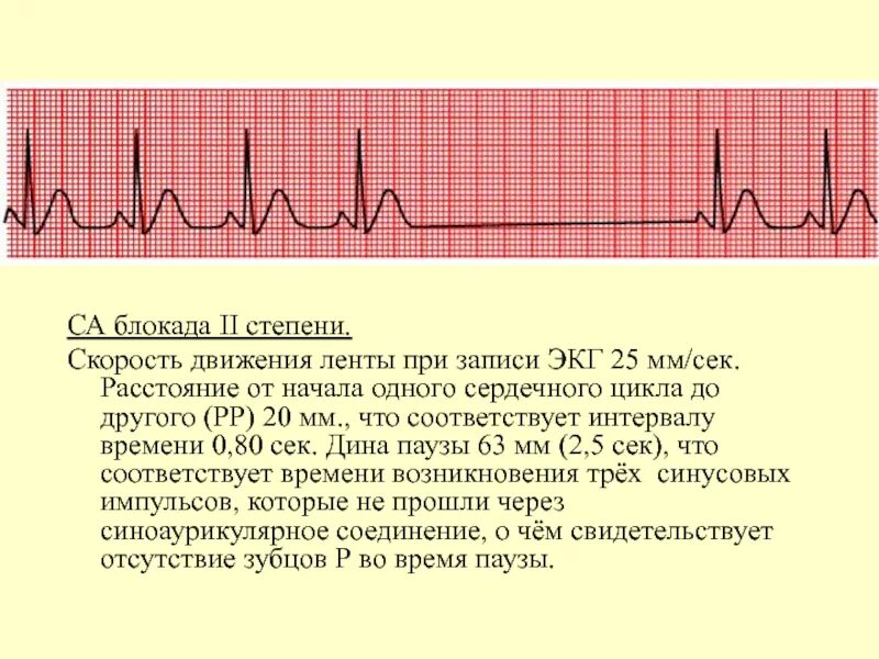 Са блокада 2 степени Мобитц 2. Синоатриальная блокада Мобитц 1 ЭКГ. Блокада са узла ЭКГ. Са блокада 2 ст на ЭКГ. Са блокада степени