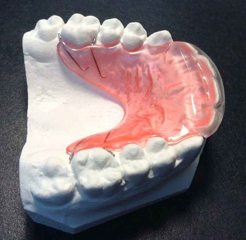 Пластинка Брюкля ортодонтия. Накусочная пластинка Катца. Пластинка Катца ортодонтия. Аппарат Катца в ортодонтии. Лечебная пластина